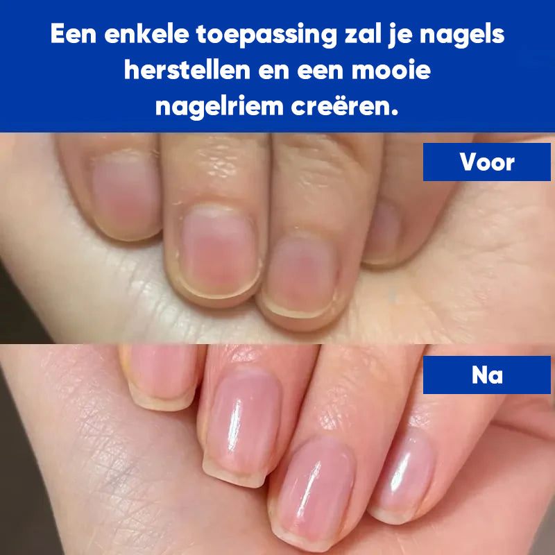 Antischimmel Nagel Reparatie Oplossing