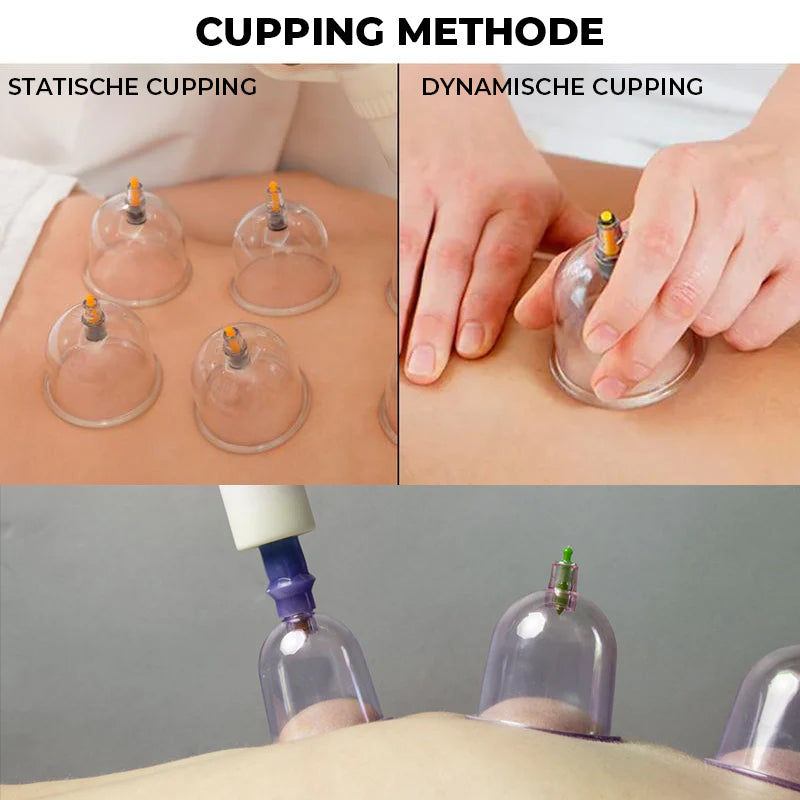 Cuppingset voor massagetherapie
