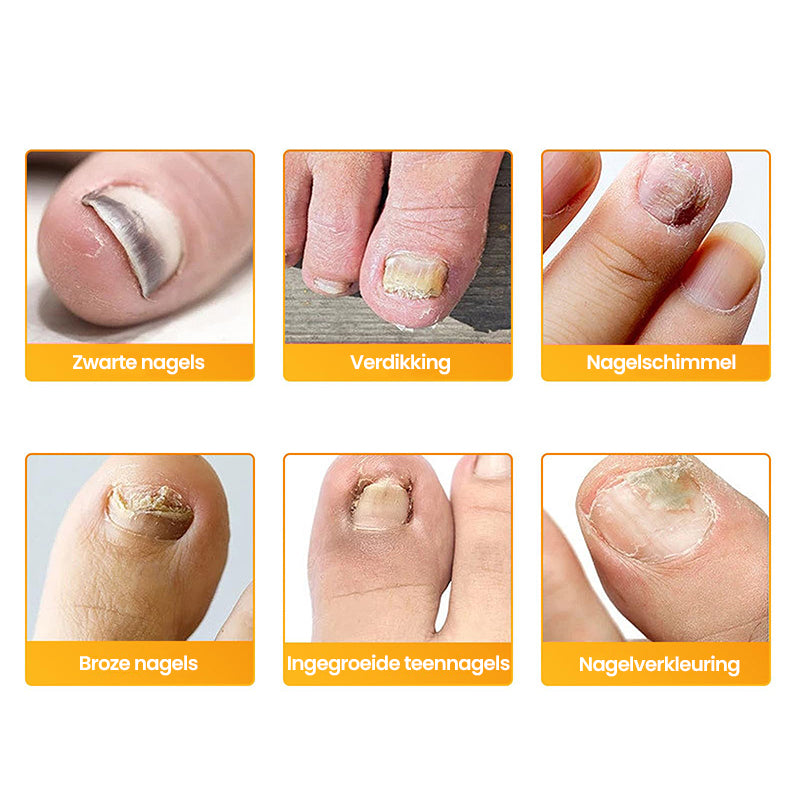 Aanbieding - Schimmelnagelpleisters