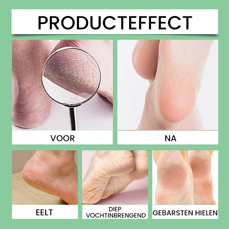 Eeltverwijderaar voor voeten