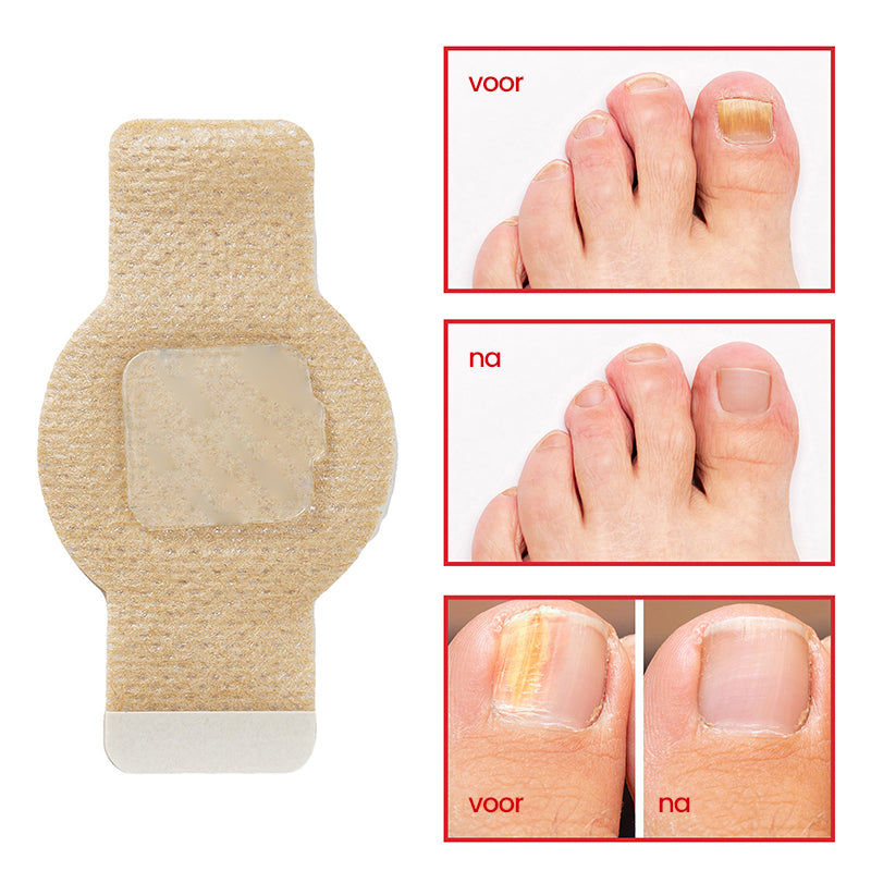 Aanbieding - Schimmelnagelpleisters