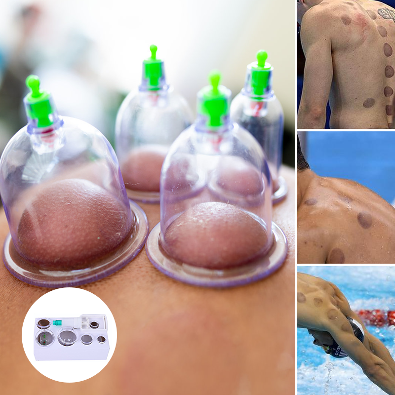 Cuppingset voor massagetherapie