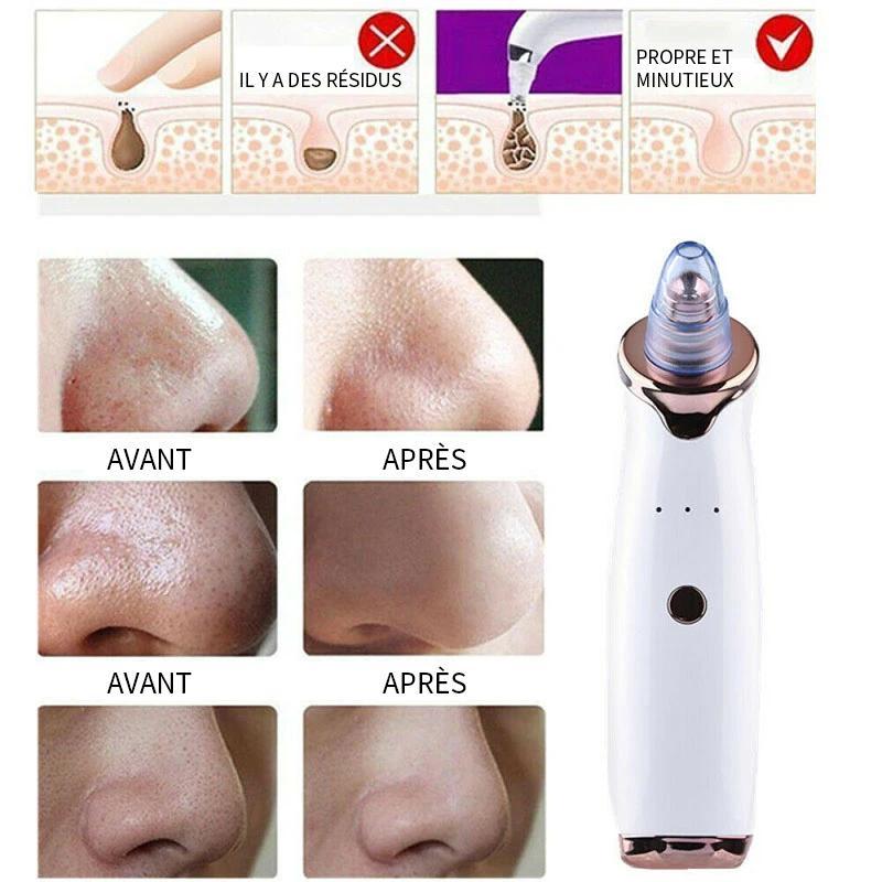Instrument de Beauté pour Enlever les Points Noirs (Blackheads) et Réparer les Pores