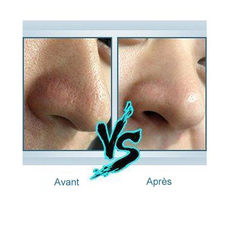 Épurateur du Visage à Vibration Ultrasonique